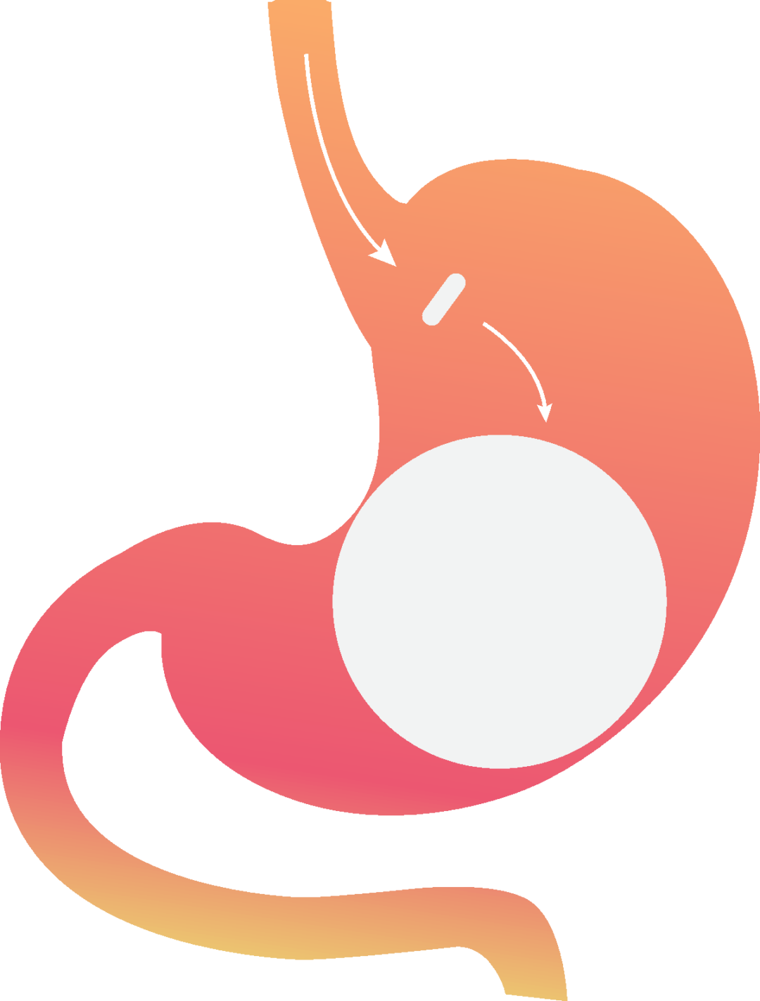 En que consiste el programa balón gastrico allurion 2025 - Dr. Javier ...