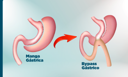 CONVERSIÓN DE MANGA GÁSTRICA A BYPASS ¿Cuándo se debe hacer?