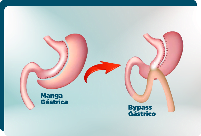 CONVERSIÓN DE MANGA GÁSTRICA A BYPASS ¿Cuándo se debe hacer?